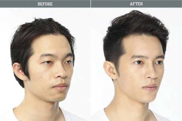 before_and_after_photos_of_korean_plastic_surgery_640_07