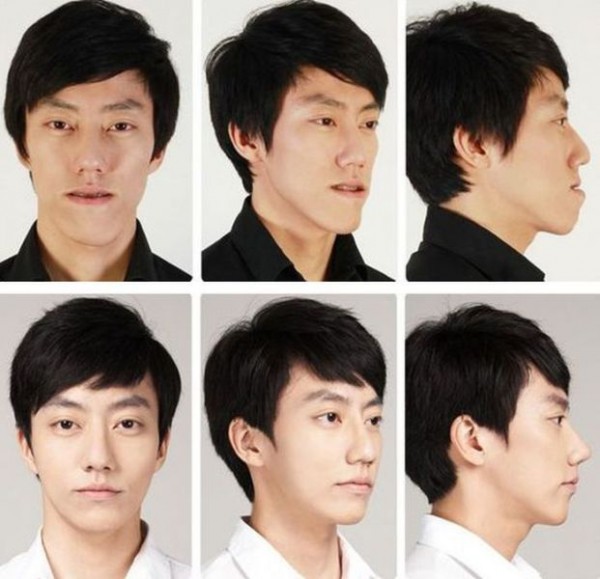 before_and_after_photos_of_korean_plastic_surgery_640_12