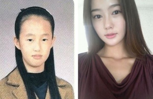 before_and_after_photos_of_korean_plastic_surgery_640_19