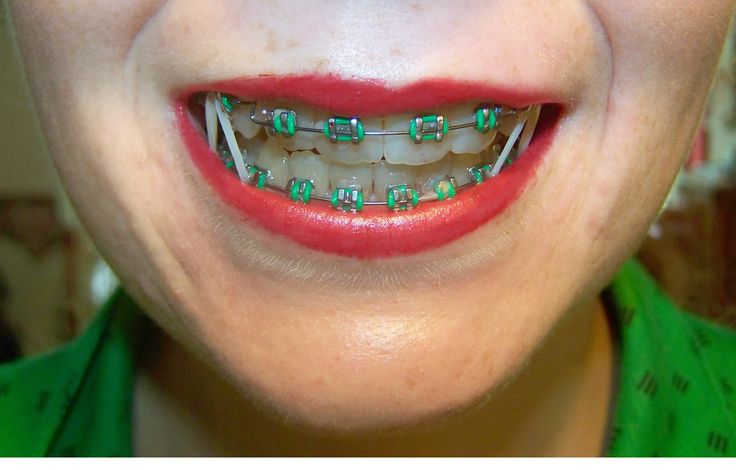 El Alambre De Los Brackets Me Lastima